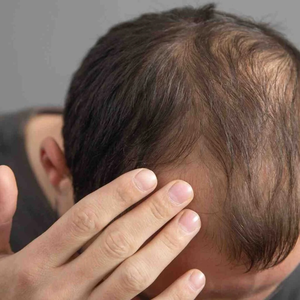 Hair Fall & Alopecia